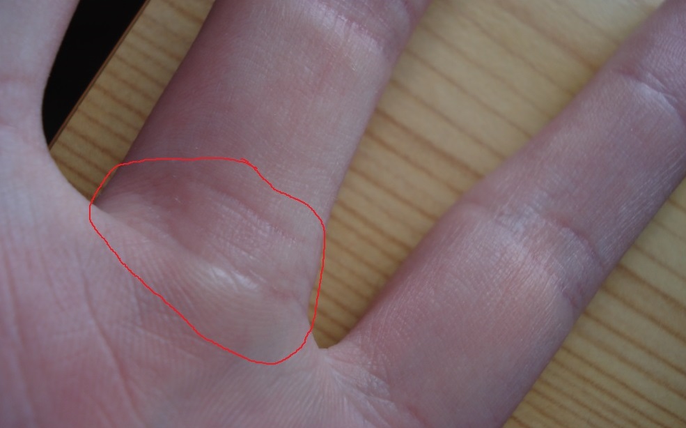 Knubbel am Fingergelenk werweisswas.de